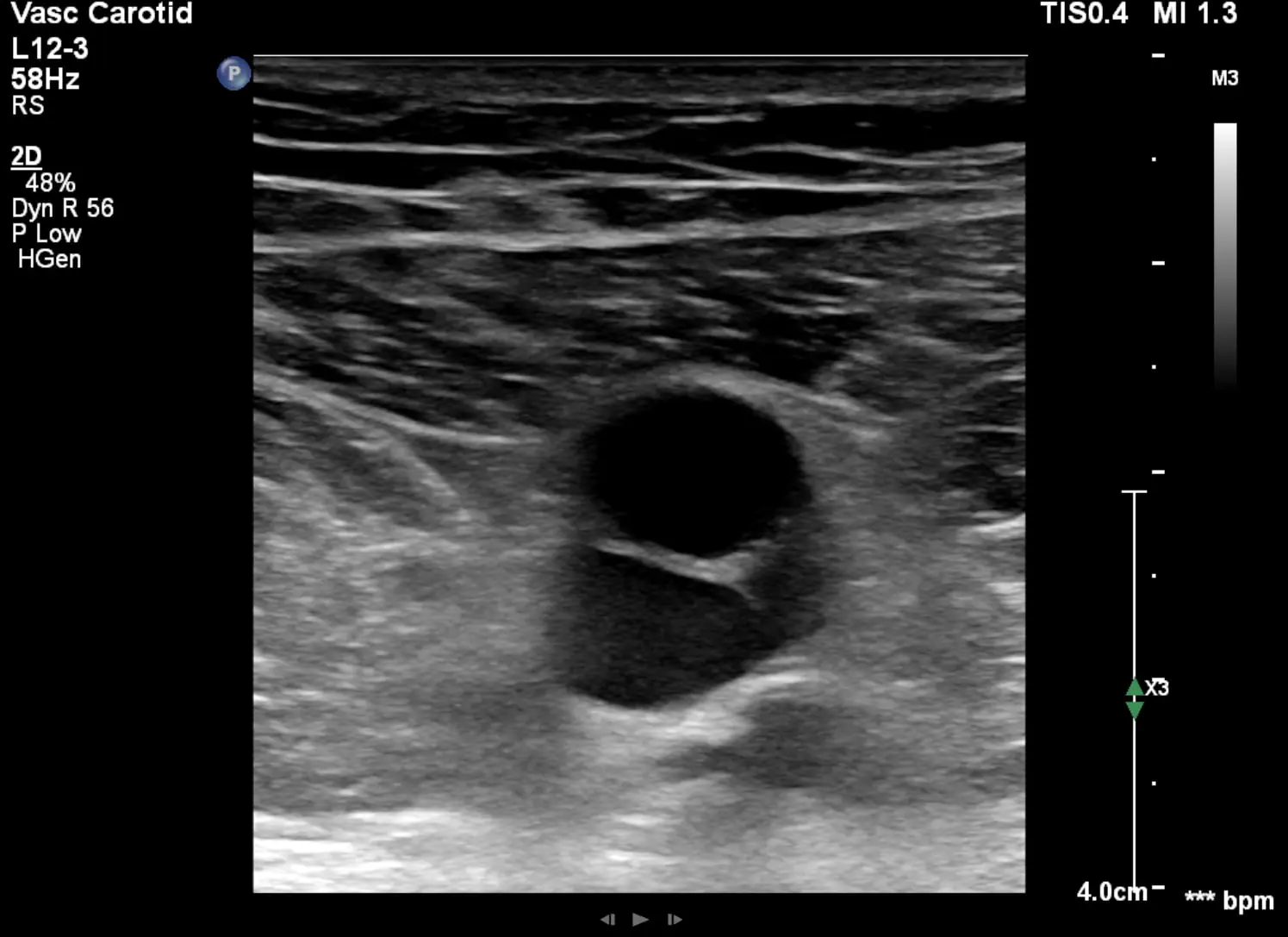 Beinvenen Ultraschall TVT-Ausschluss