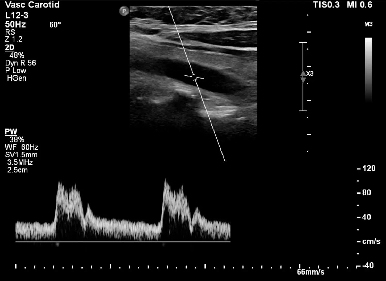 Carotisdoppler Halsgefäße Ultraschall