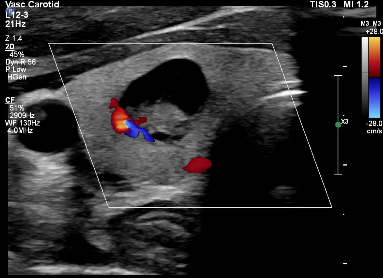 Schilddrüsensonografie Ultraschall